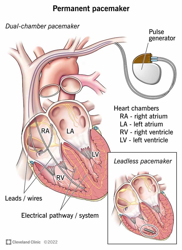 Distal Pacemaker 꽃같은 모양의 새 심장박동기···작동시 고통·배터리 없다 - 테크42